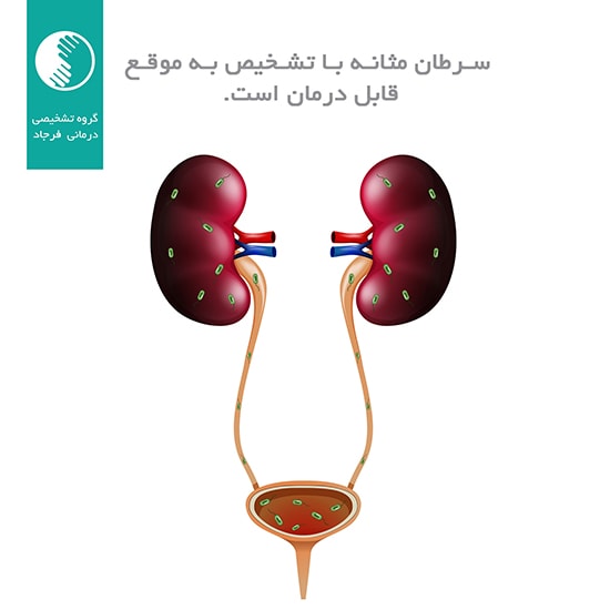 سرطان مثانه از علائم و تشخیص تا درمان