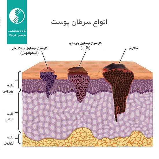 انواع سرطان پوست و روشهای پیشگیری، تشخیص و درمان