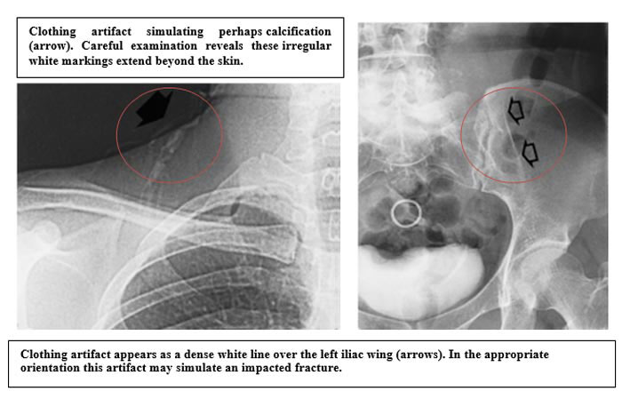 Clothing artifact simulating perhaps calcification (arrow). Careful examination reveals these irregular white markings extend beyond the skin - Clothing artifact appears as a dense white line over the left iliac wing (arrows). In the appropriate orientation this artifact may simulate an impacted fracture 