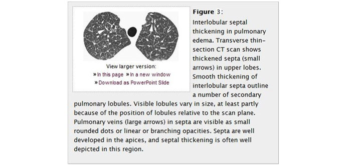 CT Paterns of Abnormality and Anatomic Distribution 2