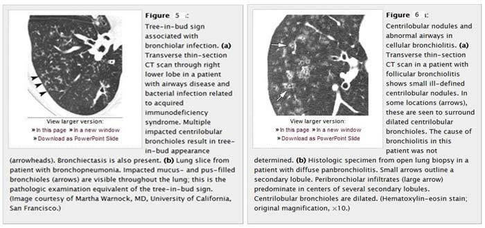 CT Paterns of Abnormality and Anatomic Distribution 4