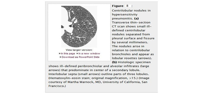 CT Paterns of Abnormality and Anatomic Distribution 6