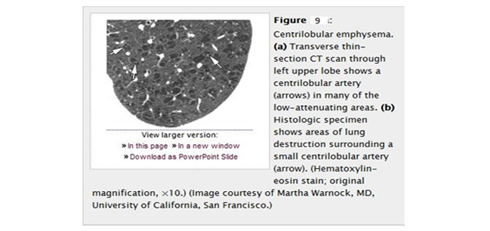 CT Paterns of Abnormality and Anatomic Distribution 7