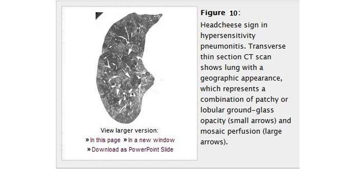 CT Paterns of Abnormality and Anatomic Distribution