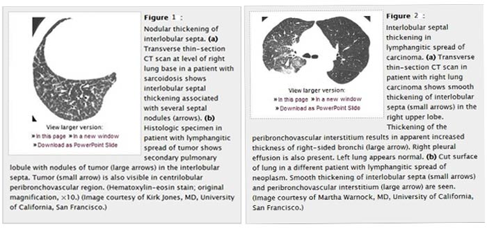 CT Paterns of Abnormality and Anatomic Distribution 1