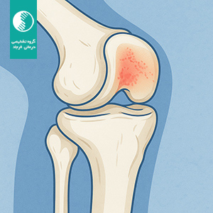 نرمی غضروف کشکک زانو (Chondromalacia Patella) چیست؟