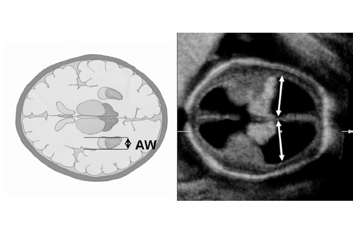  - گروه ?????? ????? - فرجاد قم - شکل شماره 1- اندازه گیری دیامتر طرفی بطن ها - (AW: Atrial Width)