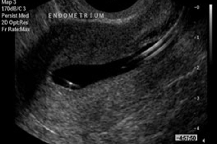 نمای اندومتر نرمال در سونوهیستروگرافی