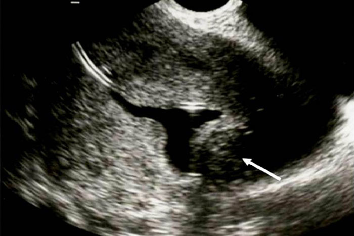 میوم ساب موکوزال (Leiomyoma) 