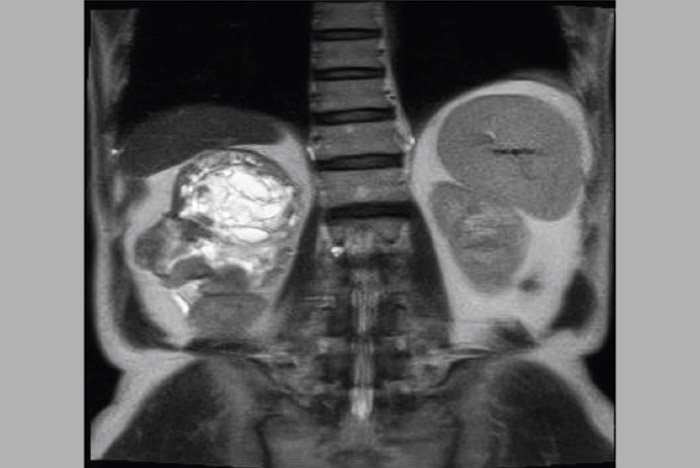 Figure 1. Magnetic resonance imaging showed right retro- peritoneal mass with hemorrhage and calcification. - farjadgroup - farjad