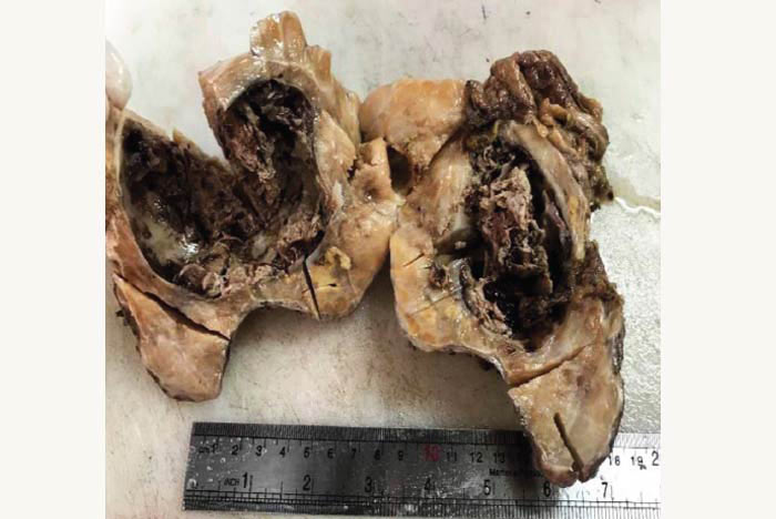 Figure 2. Gross examination of retroperitoneal mass showed cystic lobulated mass. - farjadgroup - farjad