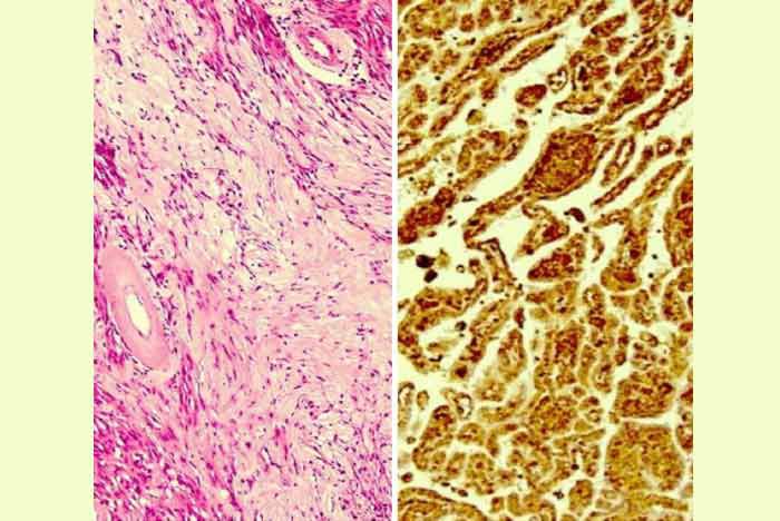 Figure 3. Histopathologic and immunohistochemistry ex- amination showed Schwannoma with spindle cells arranged (left) and positive S100 (right) staining. - farjadgroup - farjad