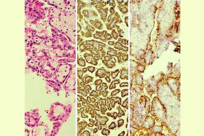 Figure 4. Histopathologic and immunohistochemistry examination showed papillary architecture with fibrovascular cores, infiltrated by neutrophils and foamy macrophages (left), positive Cytokeratin 7 (middle), and positive CD10 (right) staining. - farjadgroup - farjad
