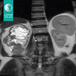 Synchronous Retroperitoneal Schwannoma and Incidental Papillary Renal Cell Carcinoma