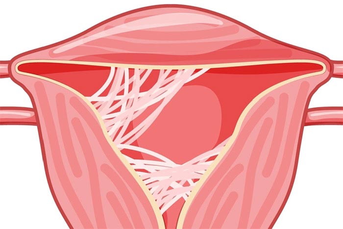چسبندگی رحم یا سندرم آشرمن
