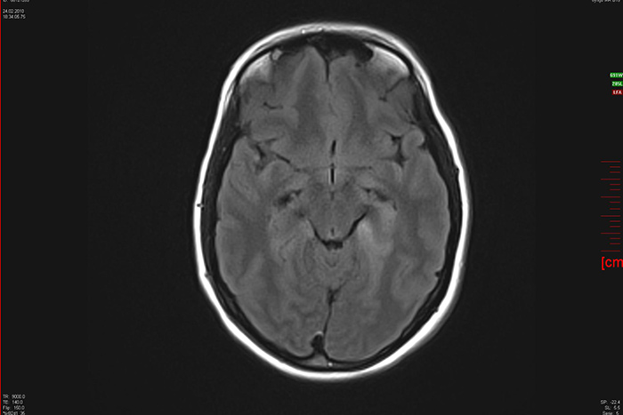 encephalitis-herpes - مقاله انسفالیت هرپسی - دکتر مریم مشایخی