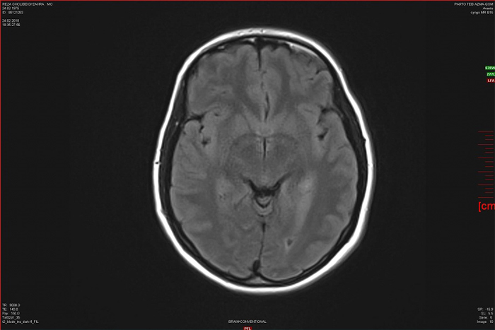 encephalitis-herpe - انسفالیت هرپسی