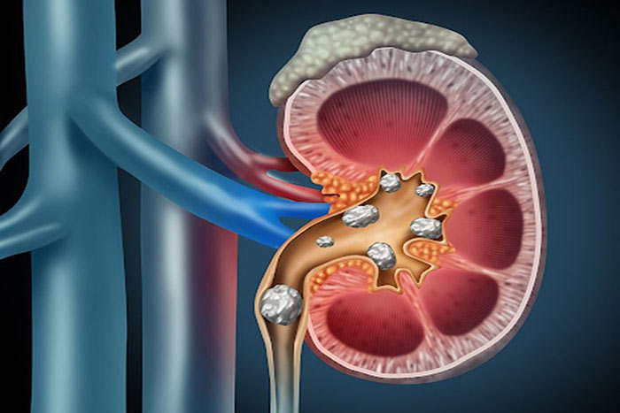 راه های درمان سنگ کلیه - فرجاد