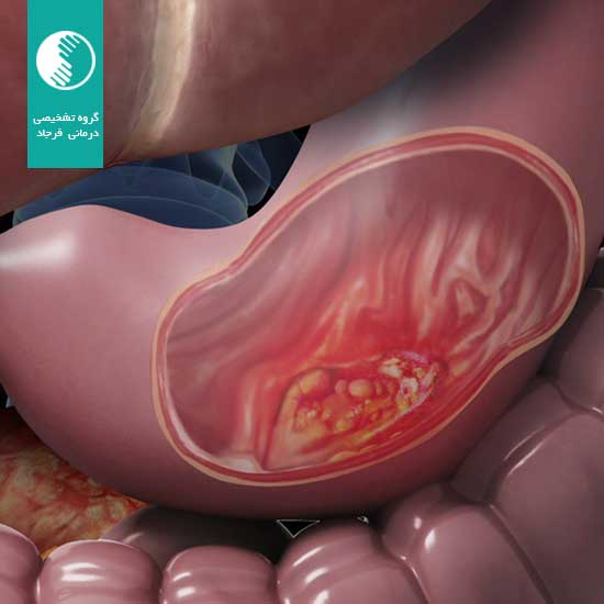 سرطان معده از پیشگیری تا تشخیص و درمان در گروه تشخیصی درمانی فرجاد