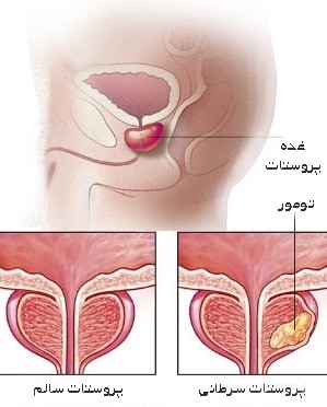 سرطان پروستات - گروه تشخیصی درمانی فرجاد